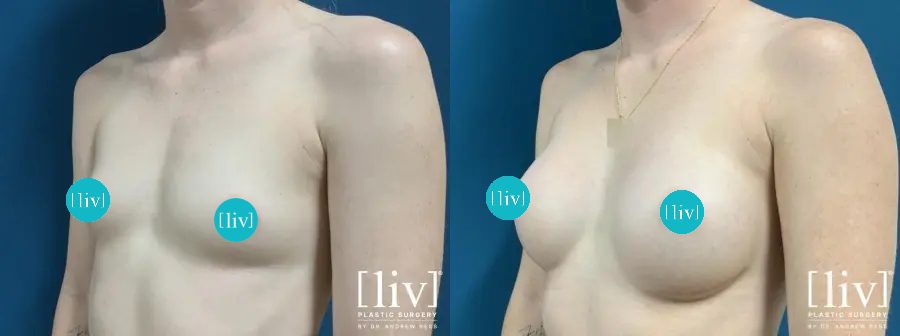 Before and After silicone breast augmentation Boca Raton Patient 3/4 view