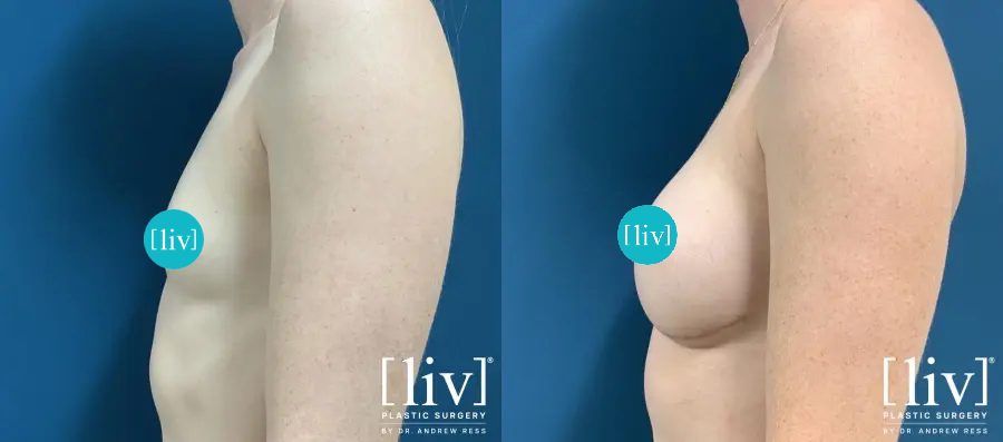 Before and After silicone breast augmentation Boca Raton Patient side view