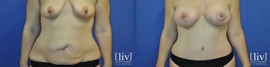 Before and After Mommy Makeover Silicone breast augmentation, Lipoabdominoplasty Boca Raton