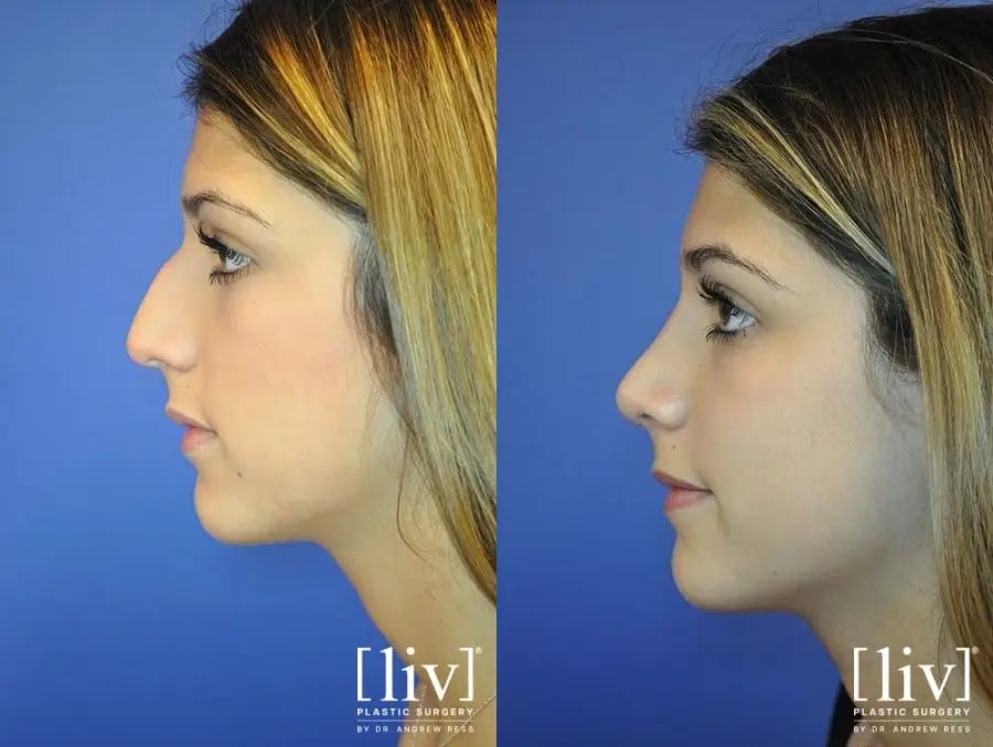 Before and After Rhinoplasty liv Plastic Surgery by Dr Andrew Ress Boca Raton