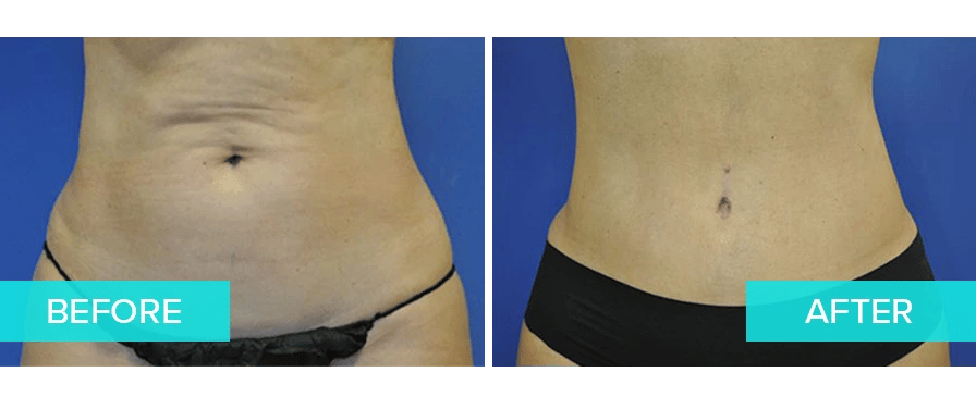 LIV-Plastic-Surgery_Tummy-Tuck-Example-1