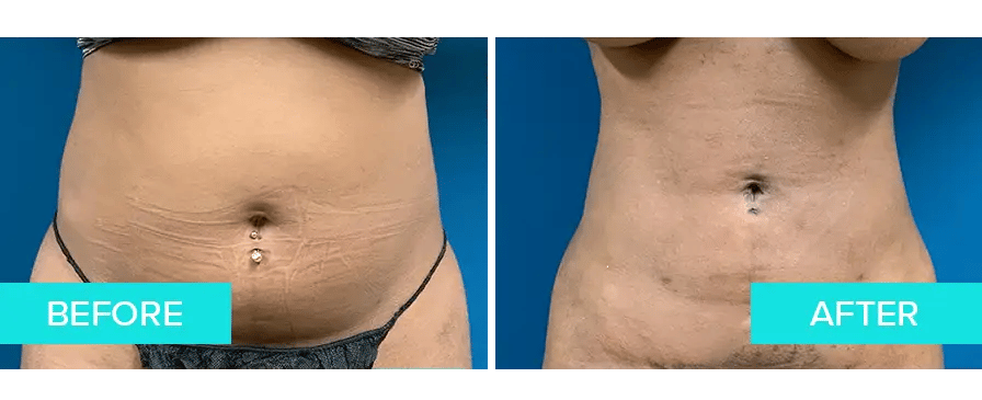 LIV-Plastic-Surgery_Tummy-Tuck-Example-2