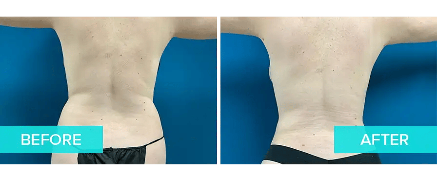 LIV-Plastic-Surgery_Tummy-Tuck-Example-3