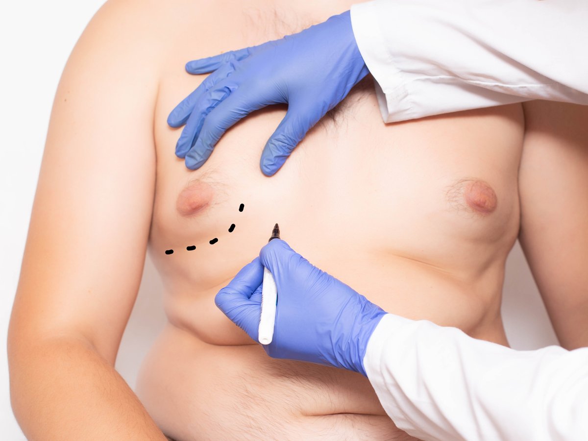 gynecomastia gynecomastia