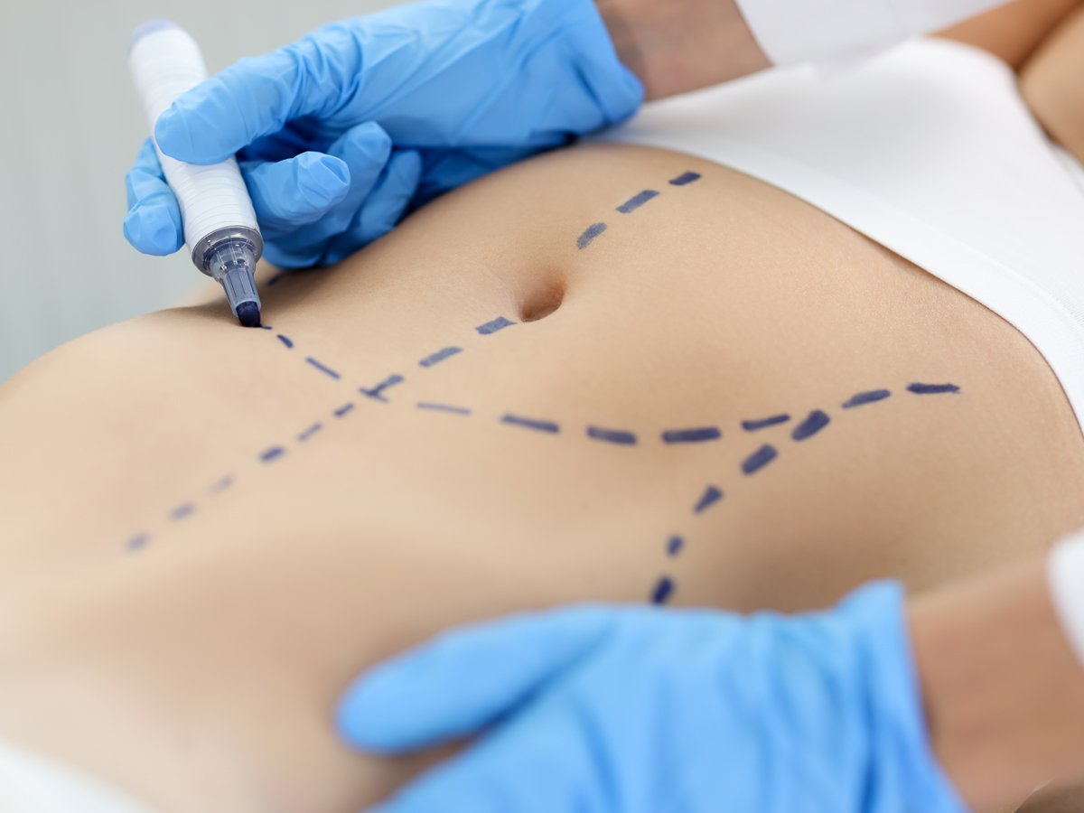 Bruggeman Plastic Surgery & Aesthetics - Flank #liposuction is a minimal  invasive outpatient procedure that removes fat around the sides and back of  the waste line. We perform this procedure in office