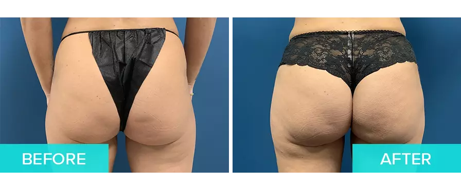 Brazilian Butt Lift Surgery Boca Raton, Buttock Implants